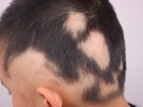 Alopesi (saç dökülmesi): nedenleri, belirtileri ve tedavileri